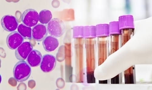 Predicting Leukemia Relapses Through Time Series and Other Advanced Techniques