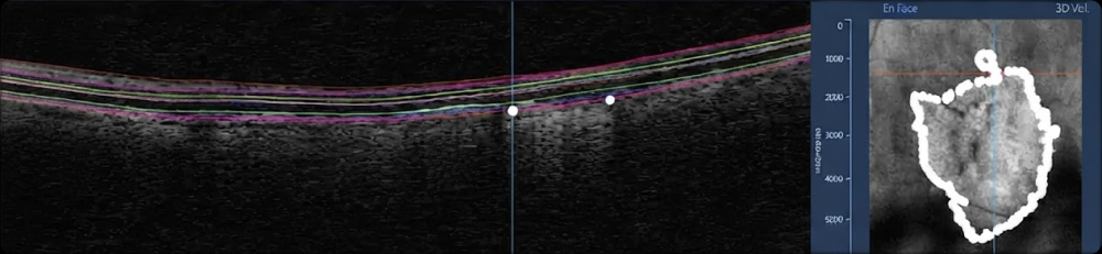 OCT · Boundary tracing · Retinal layers