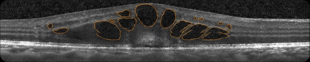 OCT · Segmentation · Intraretinal cysts