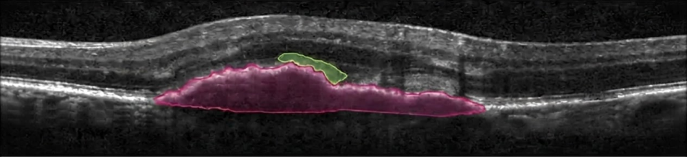 OCT · Segmentation · Subretinal fluid and pigment epithelial detachment